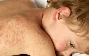 A child with measles.