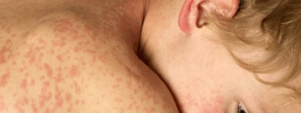 A child with measles.